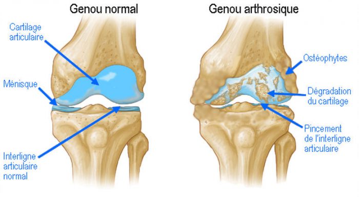 arthrose dr bousquet spécialiste du genou